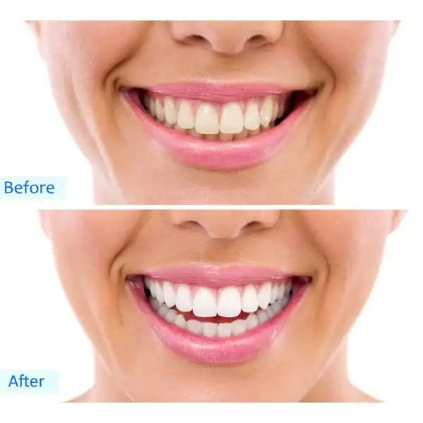 Woman's before and after results for Blue Light Teeth Whitening Aldershot