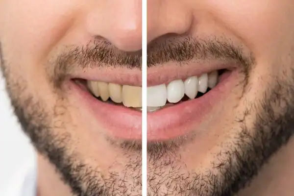 Before and after results for Blue Light Teeth Whitening Aldershot